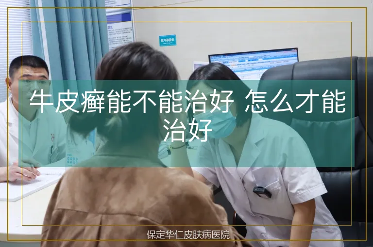 牛皮癣能不能治好 怎么才能治好